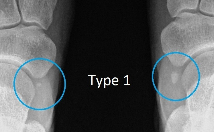 Accessory Navicular | Dr Ben Beamond | Adelaide